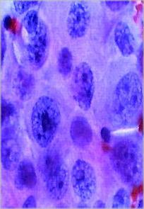 Cancer cells